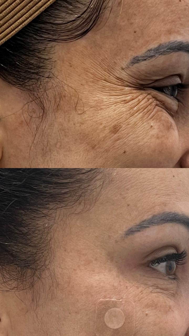 skinbooster hidratação profunda da pele - clínica Tatuapé