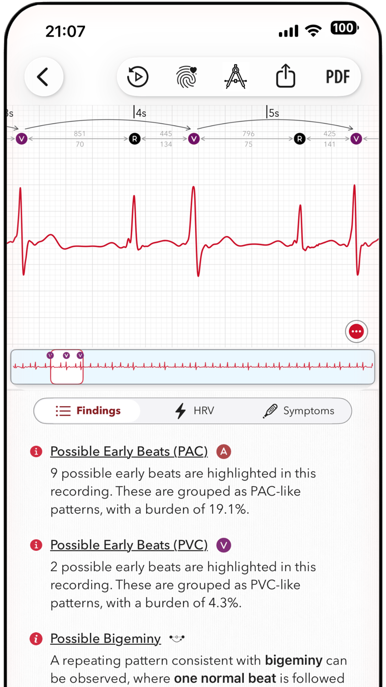 ECG+ app screenshot showing a PVC bigeminy pattern is marked on an Apple Watch ECG report
