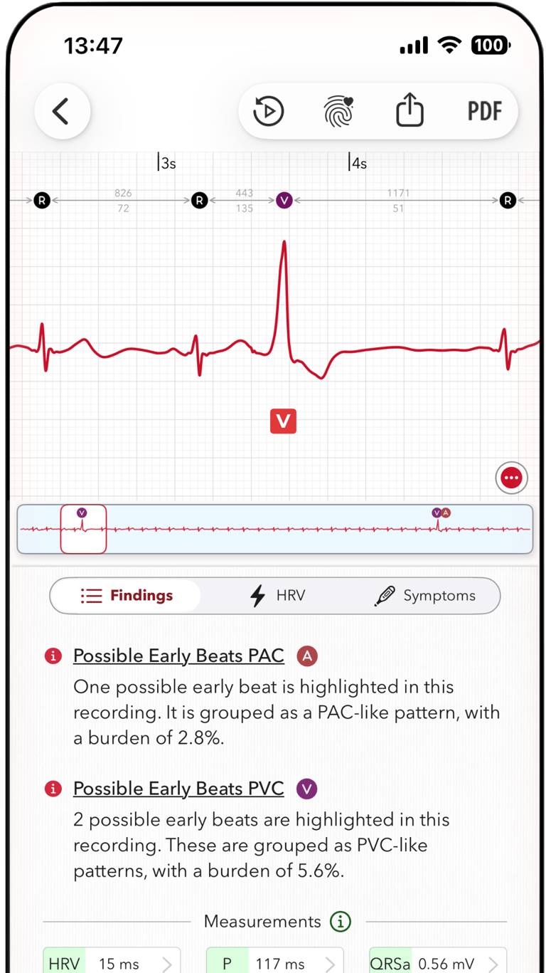 ECG+ app screenshot showing a PVC beat is marked on an Apple Watch ECG report