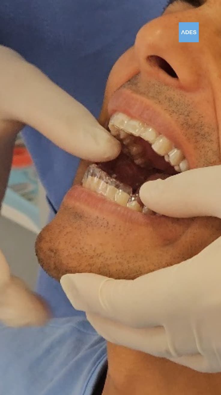 Tratamiento de ortodoncia invisible en Badajoz