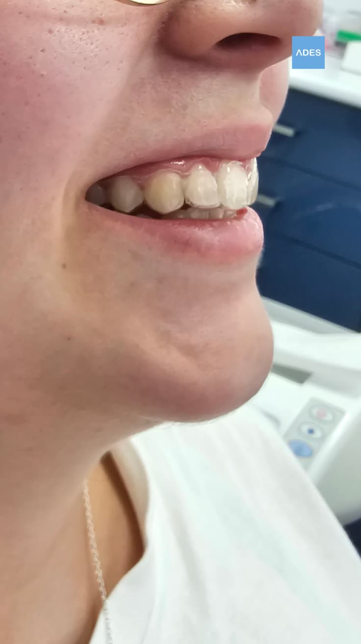 ortodoncia invisible