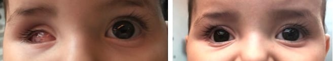 rétinoblastome évisceration enucléation prothèse oculaire oculariste nice france avfrance awada