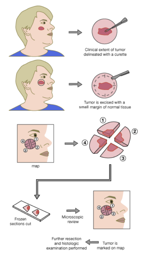 Mohs Surgery Duluth, GA