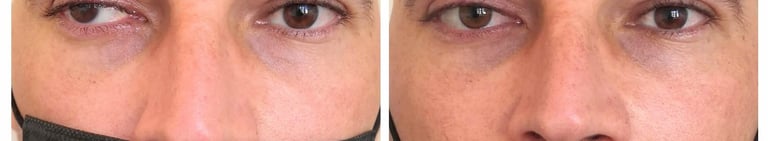 prothèse sclérale prothèse sur globe prothèse oculaire oculariste nice france avfrance awada