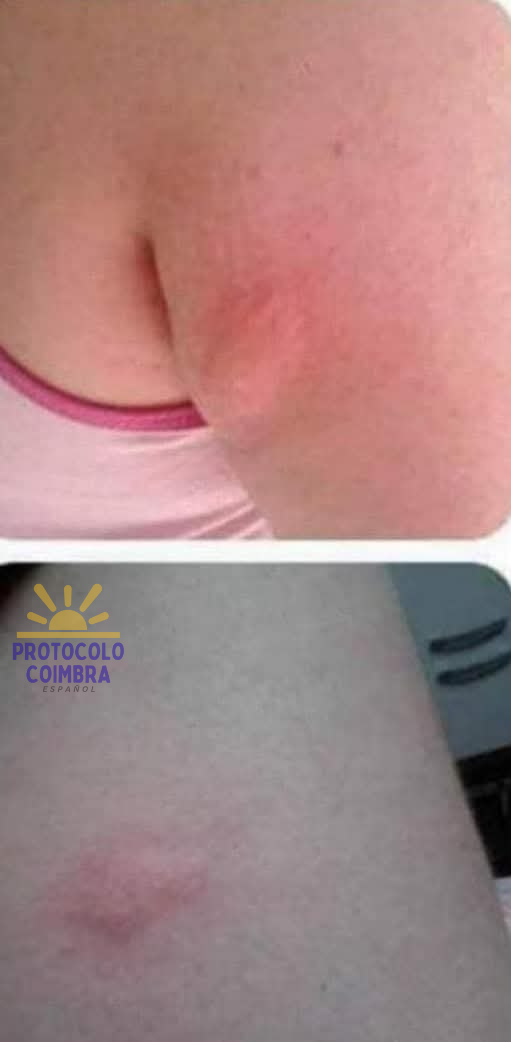 Fotos con efectos secundarios del medicamento convencional.