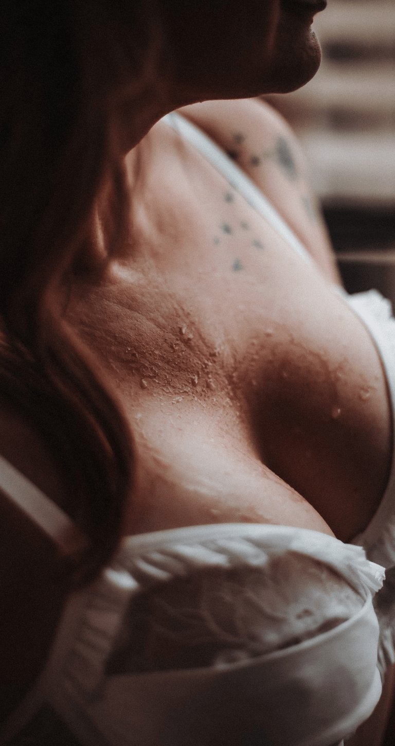 Mastopeksi uygulanmış meme