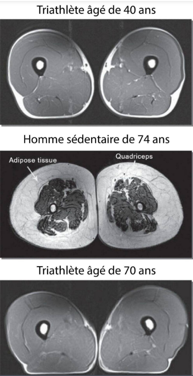 IRM muscle sarcopénie athlète sportif