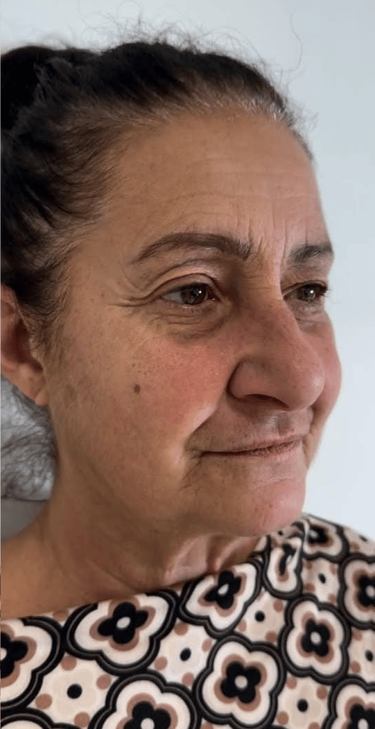 Viso PRIMA del Trattamento Lipolite Viso