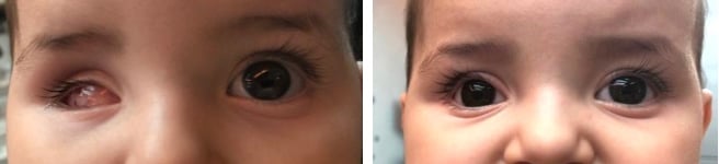 rétinoblastome évisceration enucléation prothèse oculaire oculariste nice france avfrance awada