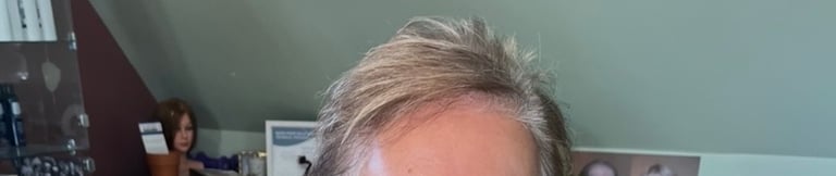 Before permanent non-surgical hair replacement #17 – thinning around the part and sides, hair lying 
