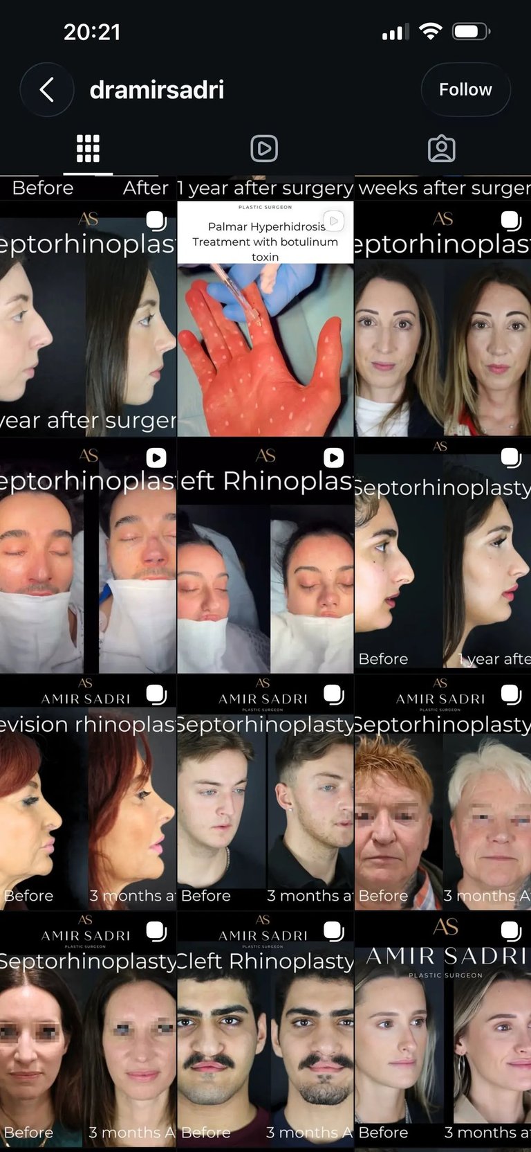 Instagram profile before redesign, featuring varied patient-result posts and limited reels