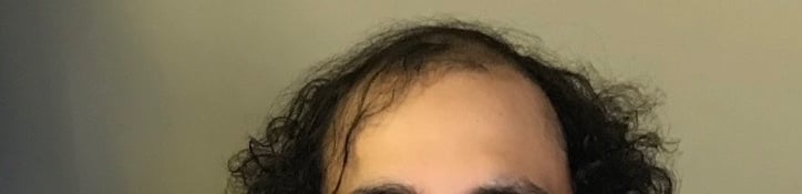 Before permanent non-surgical hair replacement #23 – thinning on top and receding hairline – man in 