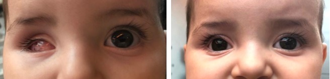 rétinoblastome évisceration enucléation prothèse oculaire oculariste nice france avfrance awada