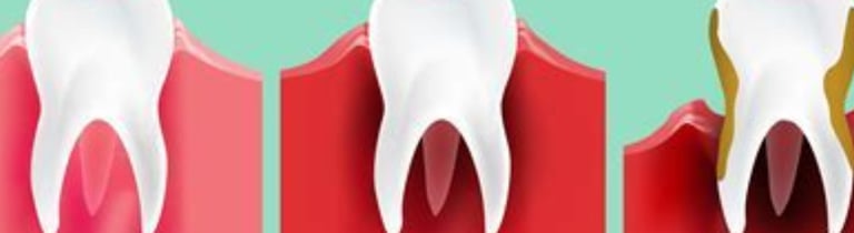 tooth decay