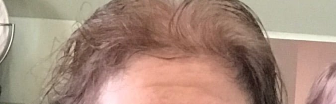 Before permanent non-surgical hair replacement #12 – fine, see-through hair on the top of the scalp 