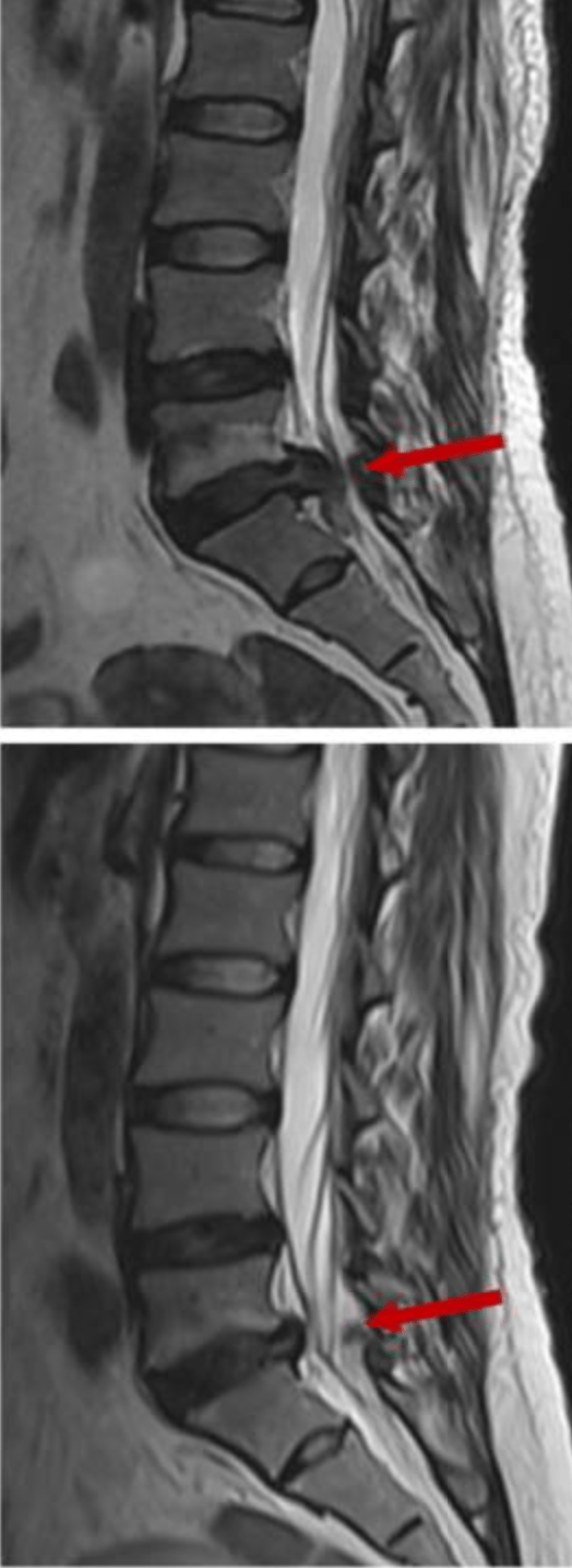 imagen de RMN de antes y después de la reabsorción de una hernia discal