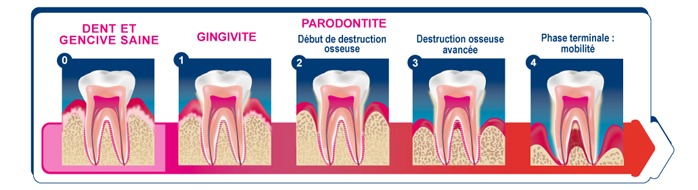 Les stades d’évolution de la parodontite source UFSBD hygiene-precision.com