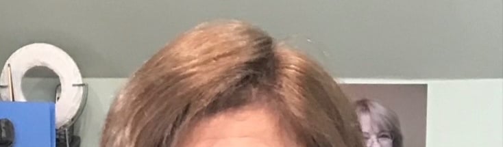 After permanent non-surgical hair replacement #12 with strand by strand method – denser top area wit