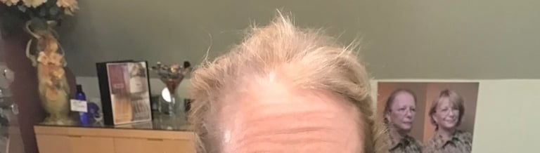 Before permanent non-surgical hair replacement #10 – advanced diffuse thinning across the top of the