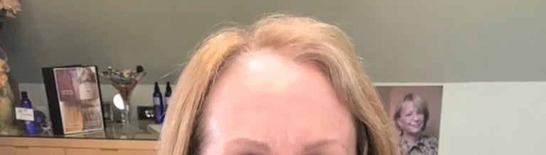 After permanent non-surgical hair replacement #10 with combined Micropoint Helix and strand by stran