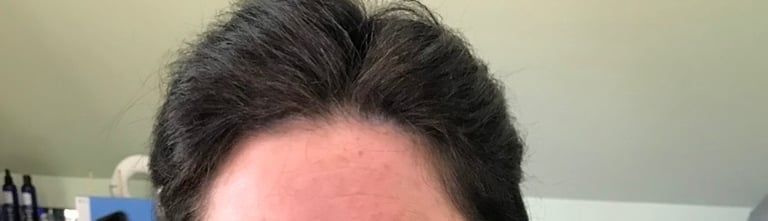 After permanent non-surgical hair replacement #9 with integration method – continuous coverage from 