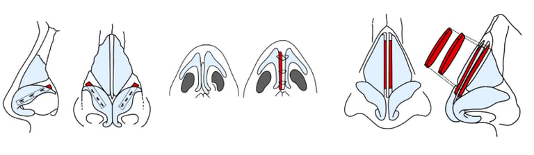 Various rhinoplasty graft graphics I created to support reels