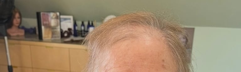 Before permanent non-surgical hair replacement #16 – noticeable patch of thinning near the crown – w