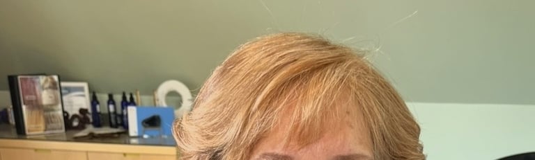 After permanent non-surgical hair replacement #16 with integration method – smooth, even coverage ov