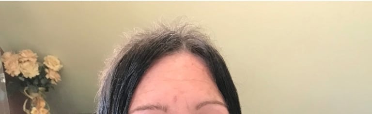Before permanent non-surgical hair replacement #9 – thinning on top and crown with visible scalp – w