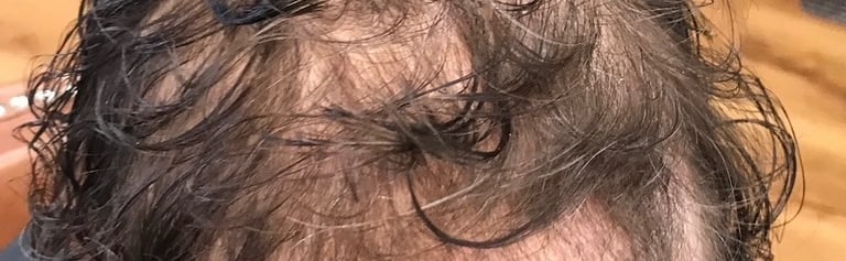 After permanent non-surgical hair replacement #10 with combined Micropoint Helix and strand by stran