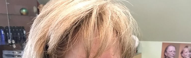 After permanent non-surgical hair replacement #11 with Micropoint Helix solution – added coverage an