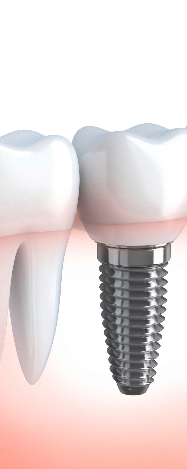 Dantų implantacija Palangoje
