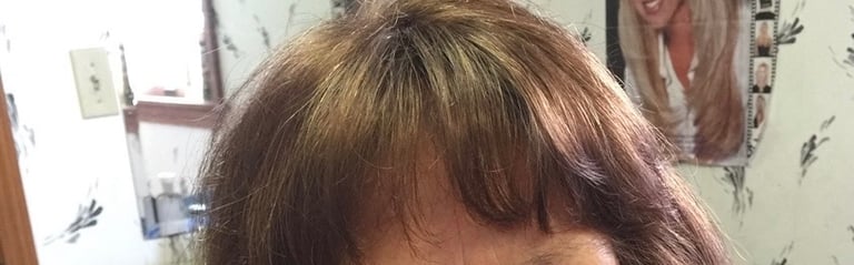 Before permanent non-surgical hair replacement #1 – diffuse thinning on top and part line – woman in