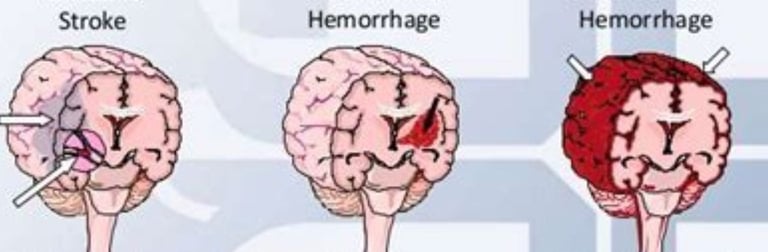 stroke types