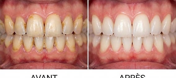 before and after dental air polishing