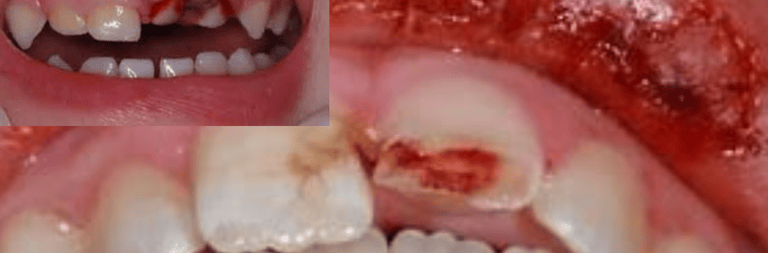 gum disease