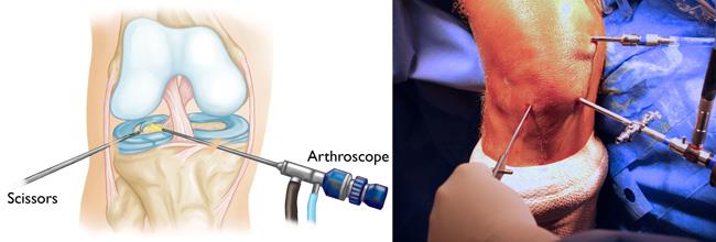 arthroscopy surgery, key hole surgery