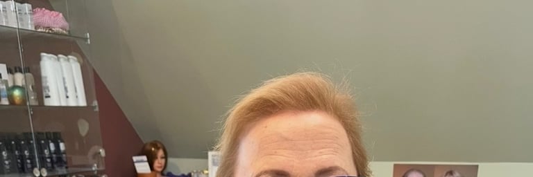 Before permanent non-surgical hair replacement #18 – fine, thinning hair making scalp visible in bri