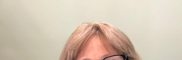 After permanent non-surgical hair replacement #8 with Micropoint Helix solution – denser part line a