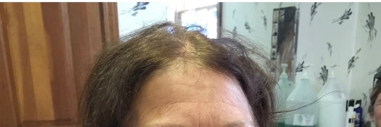 Before permanent non-surgical hair replacement #1 – diffuse thinning on top and part line – woman in