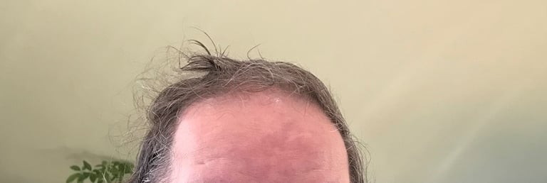  Before permanent non-surgical hair replacement #24 – advanced thinning at crown and top of scalp – 