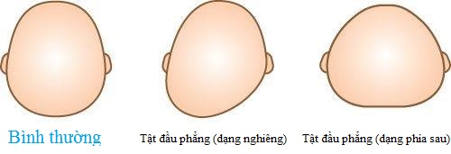 Petit Town không muốn đưa ra các hình ảnh thực tế của trẻ bị chứng méo đầu để làm minh họa