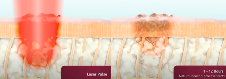 digital peel laser