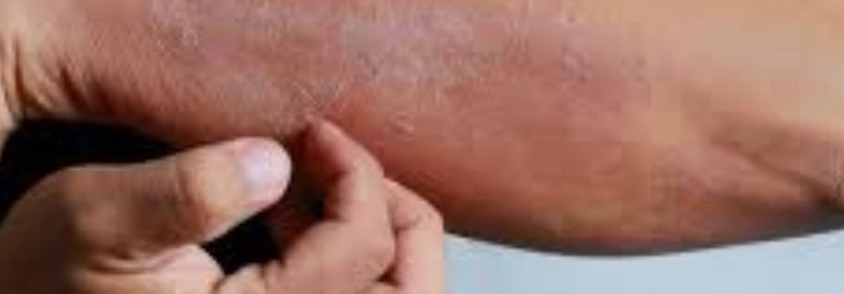 لصيام لعلاج حساسية الجلد الحكة والهرش