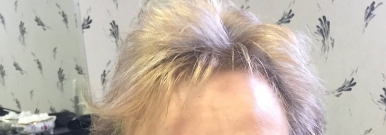 Before permanent non-surgical hair replacement #2 – visible hair loss and thinning at the crown – wo