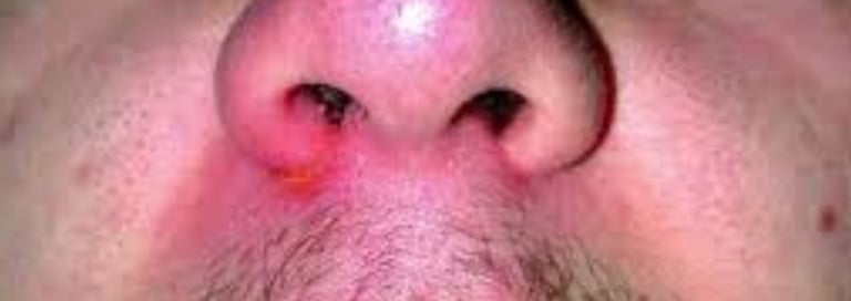 nose inflammation