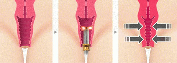 схематика як працюе ліфтинг піхви