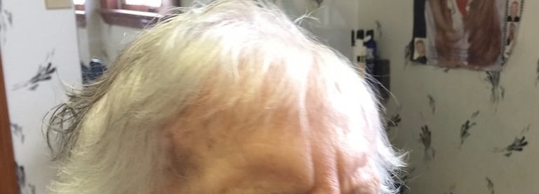 Before permanent non-surgical hair replacement #3 – overall thinning with scalp visible through the 