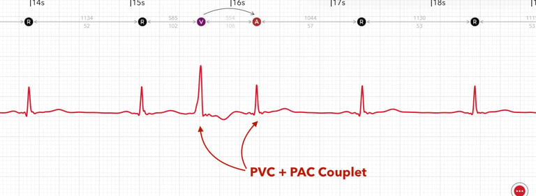 A couplet pattern of PAC + PVC is marked on an Apple Watch ECG report in ECG+