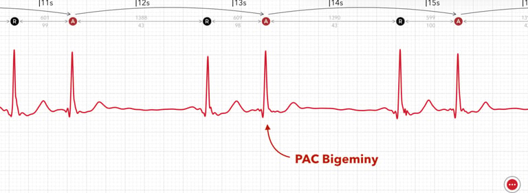 A PAC Bigeminy pattern is marked on an Apple Watch ECG report in ECG+